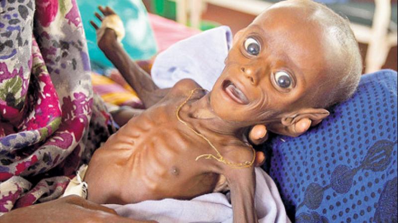 Number of Malnourished Children in Somalia Rose 40% in Feb