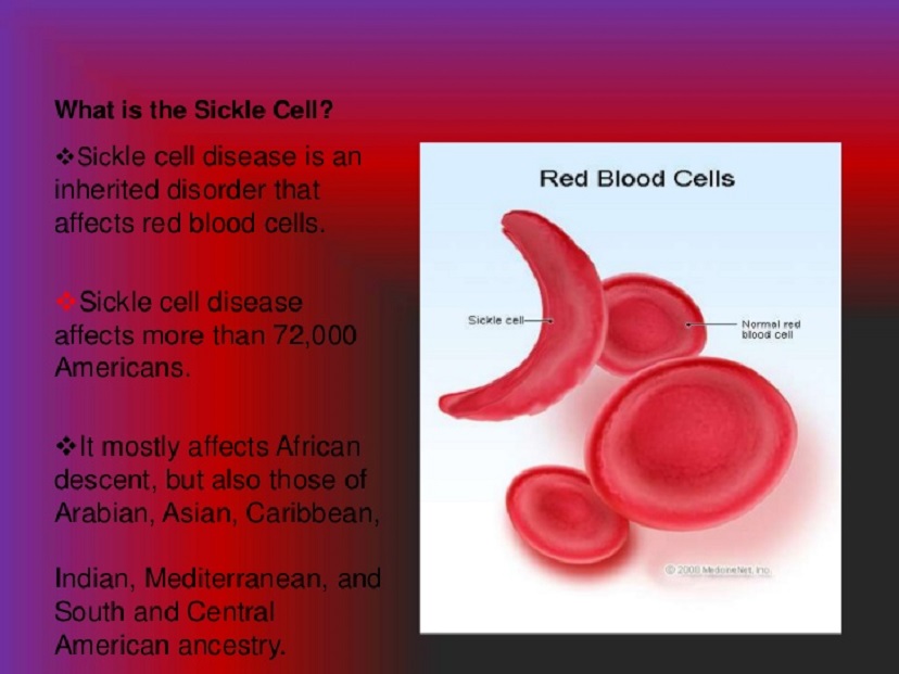 25% of Nigerians Carry Sickle Cell Gene—Expert