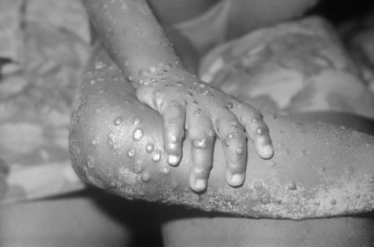 FG Refutes Alleged Deliberate Injection of Monkey Pox Virus