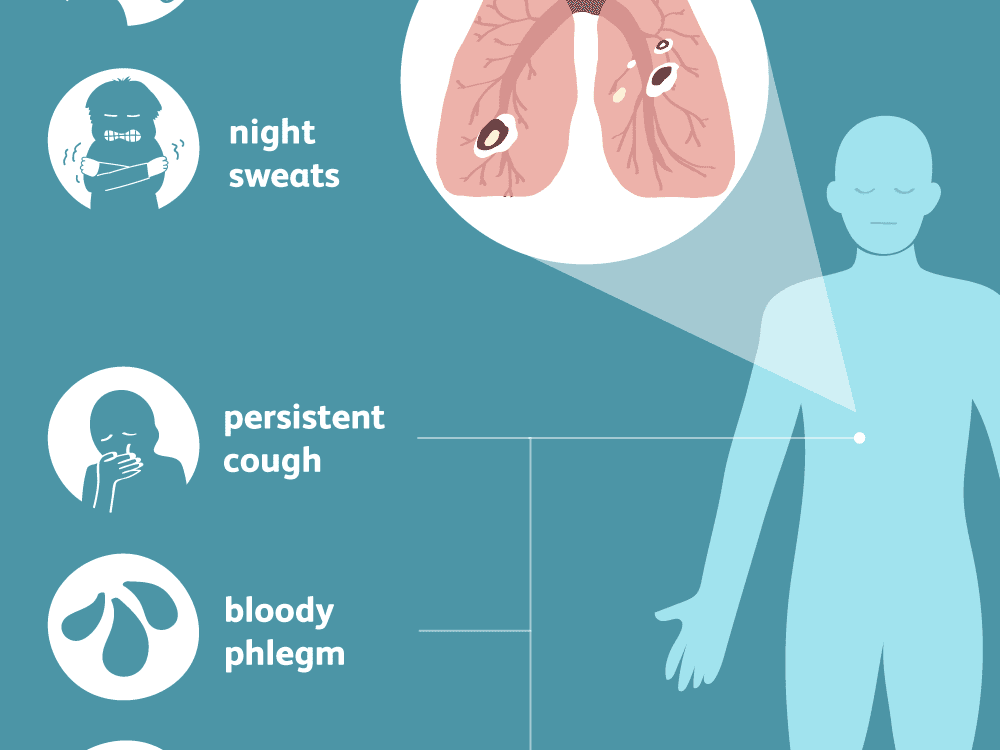 tuberculosis