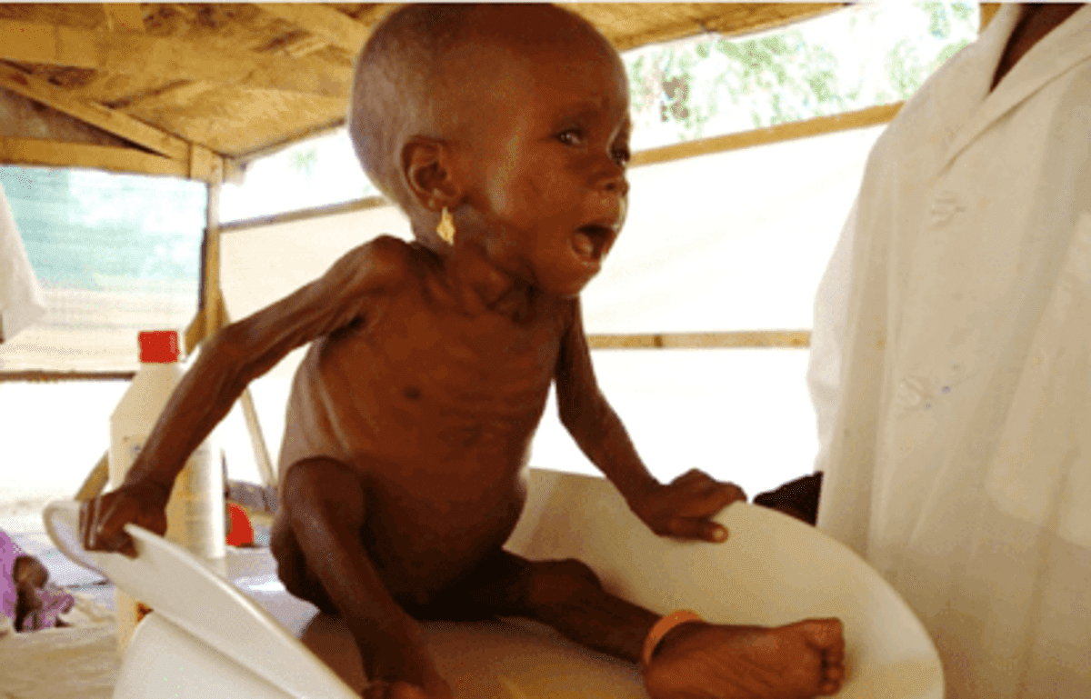 children malnutrition
