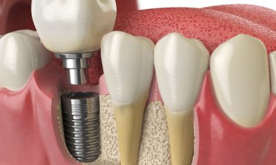 Dental implants