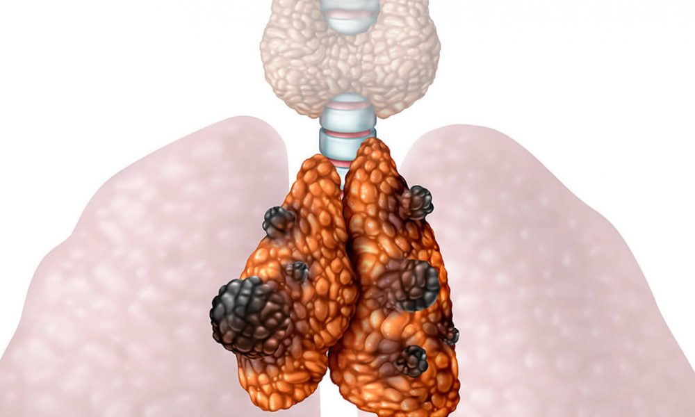 thymus cancer