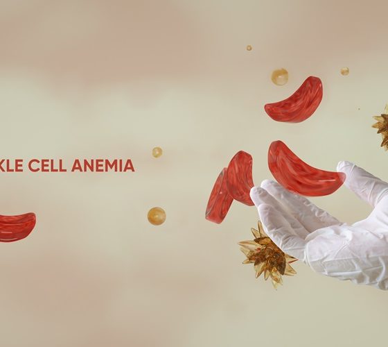 sickle cell disease