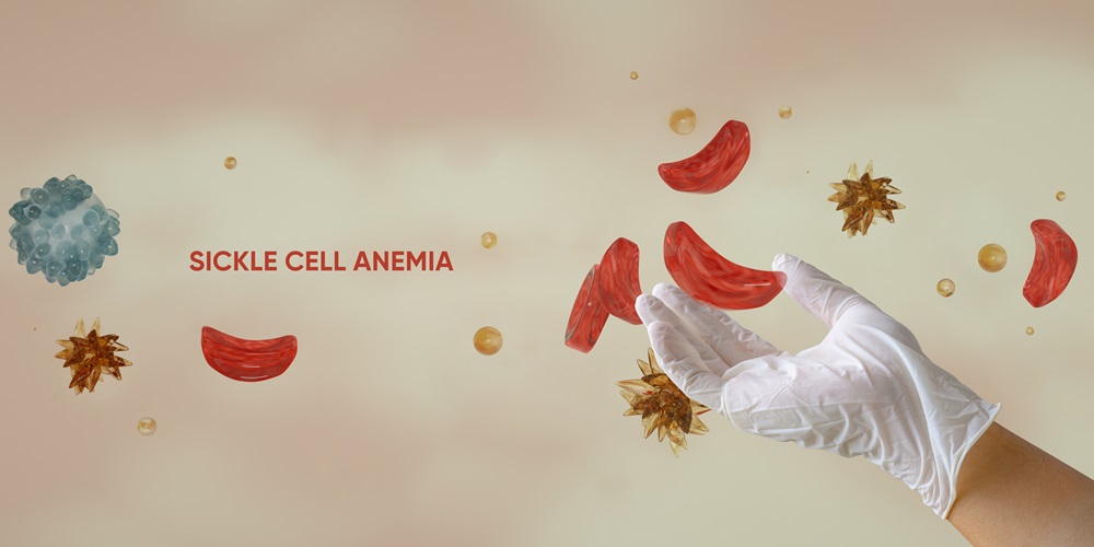 sickle cell disease