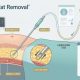 Standard Fat Removal